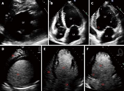 laminated Lv thrombus